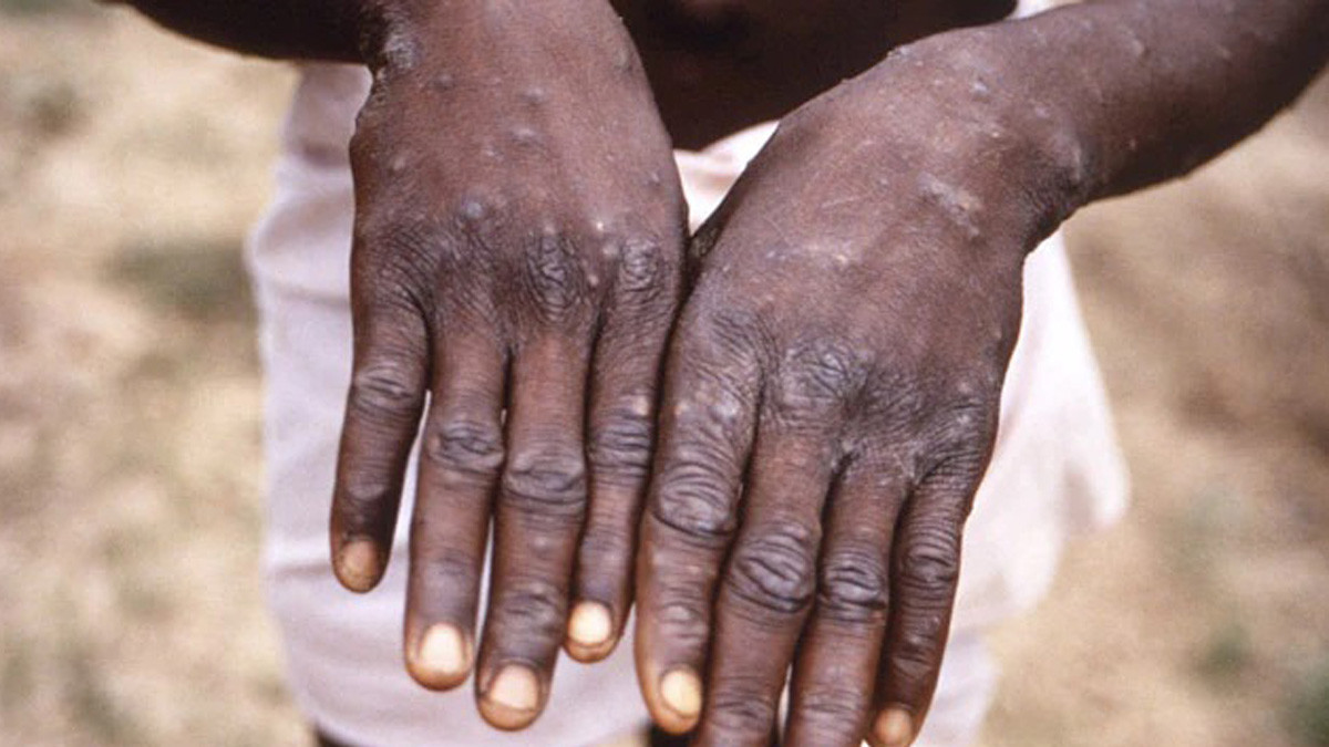 Person suspected with monkeypox confirms having contracted leprosy