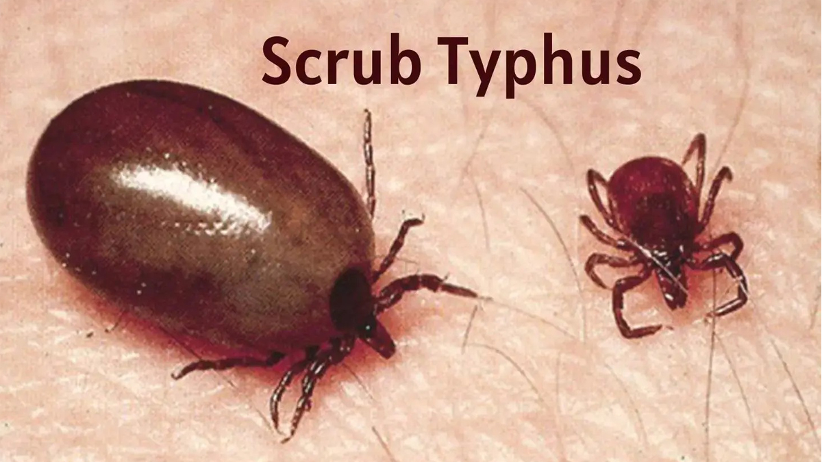 Chitwan reports 230 cases of scrub typhus