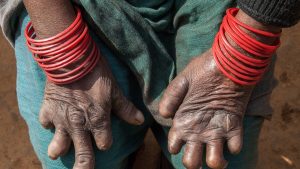 Banke and Bardiya Struggle Against Leprosy Challenges Despite Decrease in Cases