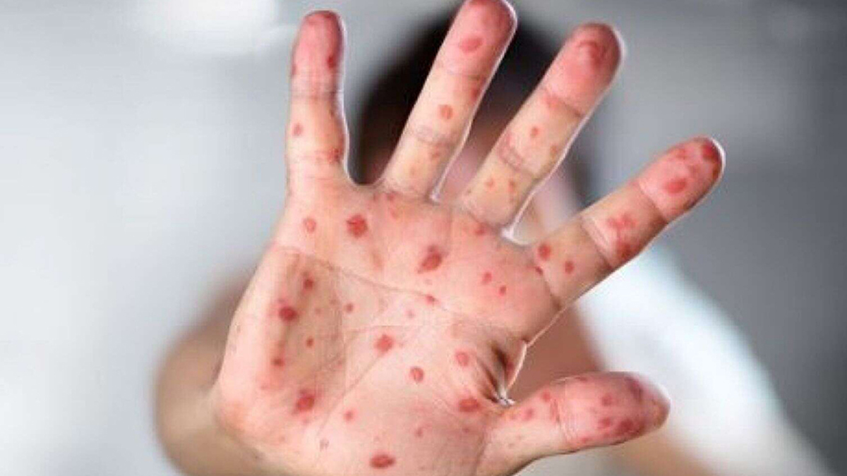 Upshot in measles cases in Banke