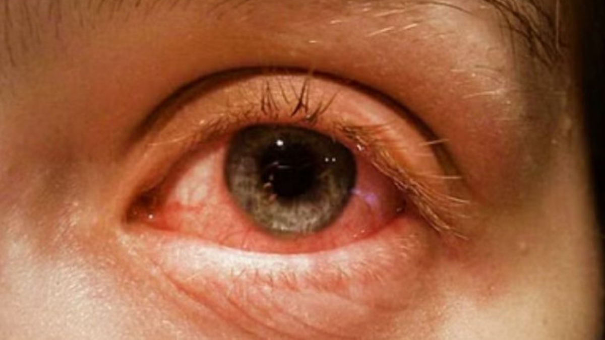 Conjunctivitis spreads in Dhading