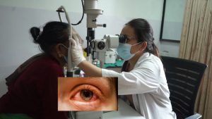 50 percent of patients visiting hospitals found suffering from conjunctivitis